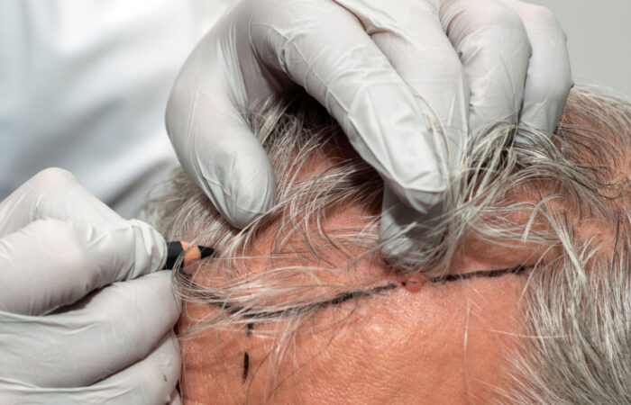 Close-up of gloved hands drawing marker-guided lines along a patient’s hairline for a cosmetic procedure on the scalp.