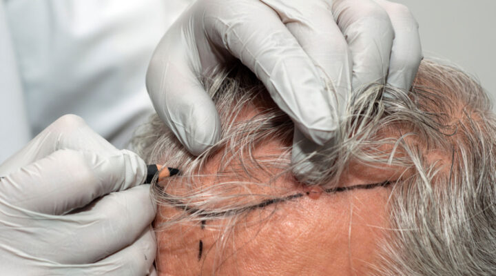 Close-up of gloved hands drawing marker-guided lines along a patient’s hairline for a cosmetic procedure on the scalp.