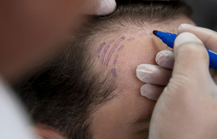 Clinician wearing gloves marks a hairline on a man's scalp with a purple marker on the skin edge of the forehead area for planning hair restoration.