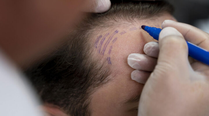 Clinician wearing gloves marks a hairline on a man's scalp with a purple marker on the skin edge of the forehead area for planning hair restoration.