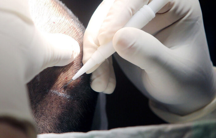 Medical professional in gloves using a precision instrument to make a scalp incision on a patient.