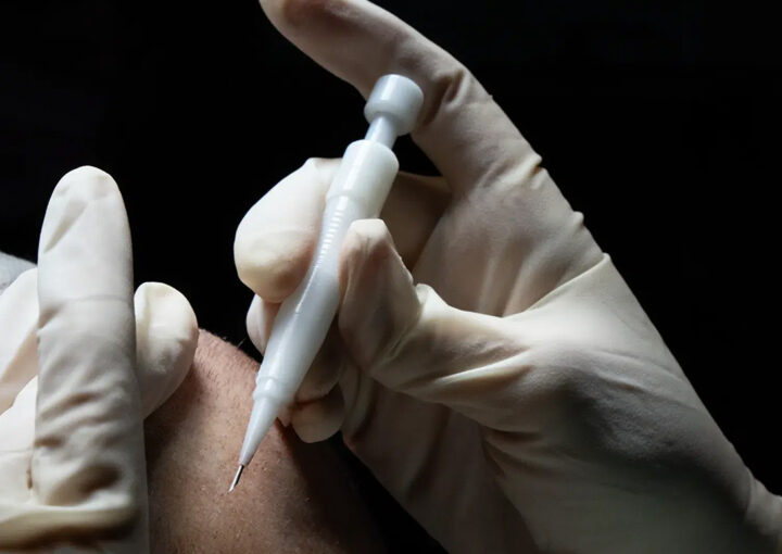 Close-up of a gloved hand injecting a patient’s skin with a small syringe-like device.