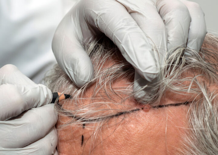 Close-up of a surgeon marking the hairline on a patient’s scalp with a marker while wearing gloves