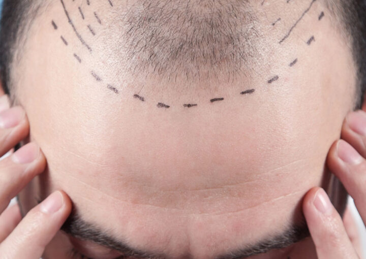 Close-up of a man's bald scalp marked with dotted lines for a hair transplant, hands on the sides for balance