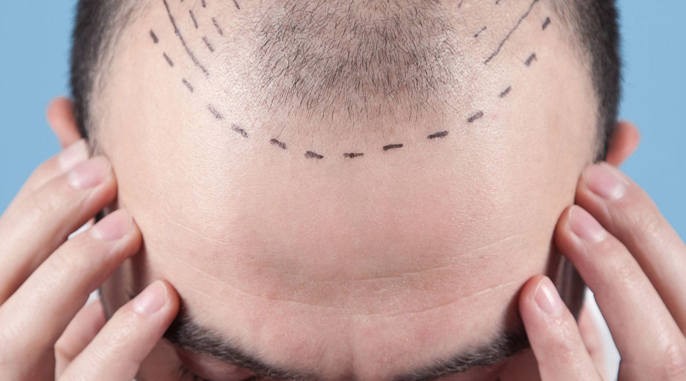Close-up of a man's bald scalp marked with dotted lines for a hair transplant, hands on the sides for balance