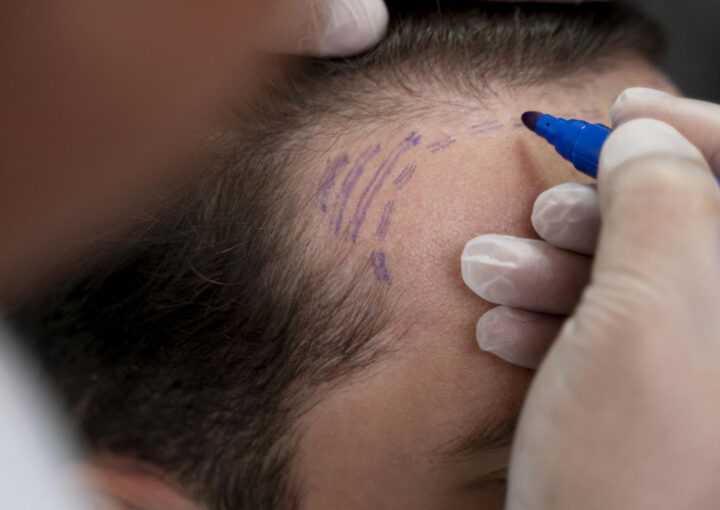 Clinician wearing gloves marks a patient’s hairline with purple pen for a procedure.