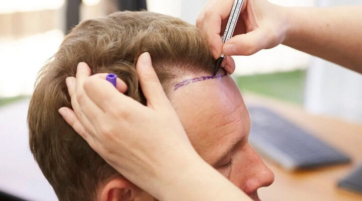 Medical professional marks a hairline on a man's forehead with a marker during a hair restoration consultation.