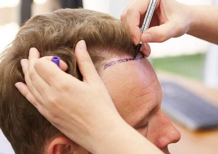 Medical professional marks a hairline on a man's forehead with a marker during a hair restoration consultation.