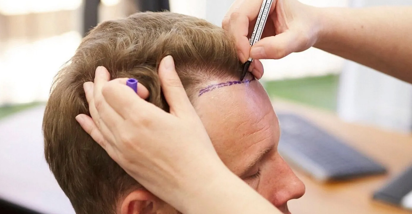 Medical professional marks a hairline on a man's forehead with a marker during a hair restoration consultation.