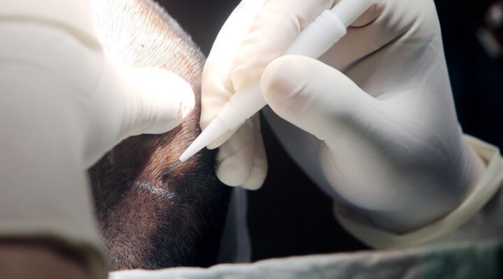 Close-up of a surgeon's gloved hands making a small skin incision with a scalpel during a medical procedure.