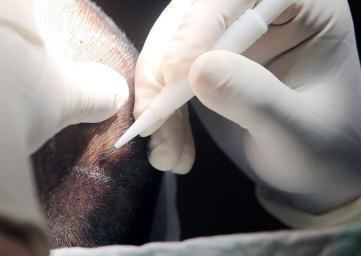 Close-up of a surgeon's gloved hands making a small skin incision with a scalpel during a medical procedure.